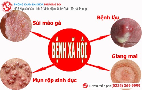 bệnh xã hội ở nữ