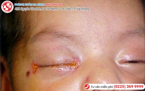 Biến chứng viêm giác mạc ở trẻ sơ sinh do nhiễm lậu Biến chứng viêm giác mạc ở trẻ sơ sinh do nhiễm lậu