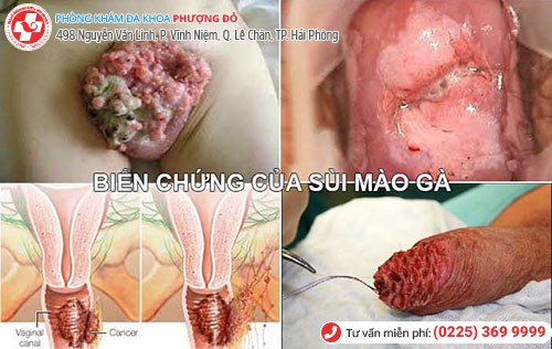 Biến chứng nguy hiểm khi bị sùi mào gà Biến chứng nguy hiểm khi bị sùi mào gà