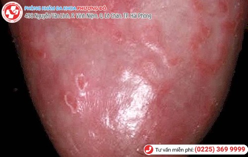 biến chứng gai sinh dục nam