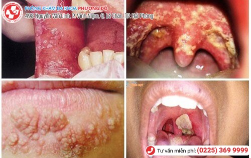 Nguy cơ ung thư vòm họng khi bị lậu ở miệng Nguy cơ ung thư vòm họng khi bị lậu ở miệng