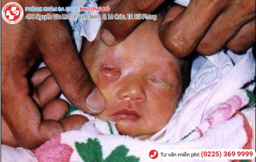 biến chứng bệnh lậu nữ