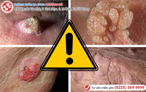 Biến chứng mụn cóc sinh dục Biến chứng mụn cóc sinh dục