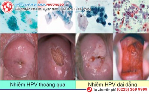 biến chứng sùi mào gà ở nữ