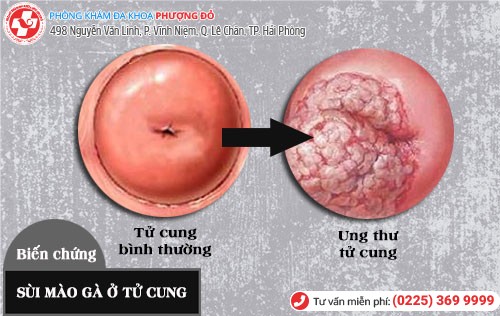 Sùi mào gà ở tử cung gây ung thư Biến chứng sùi mào gà ở tử cung