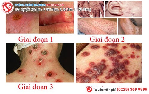 Các giai đoạn phát triển bệnh giang mai Các giai đoạn phát triển bệnh giang mai