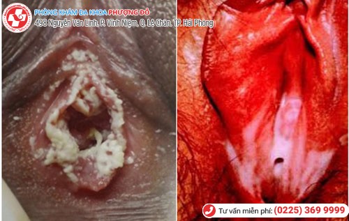 biểu hiện bệnh lậu nữ