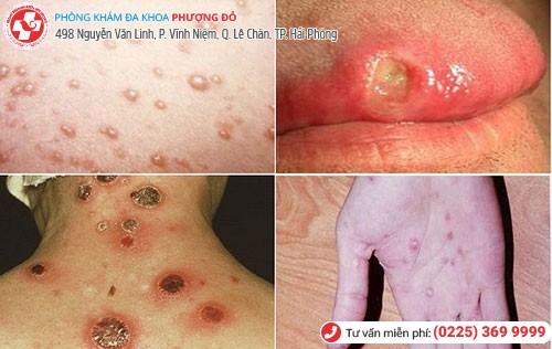 biểu hiện giang mai ở nữ