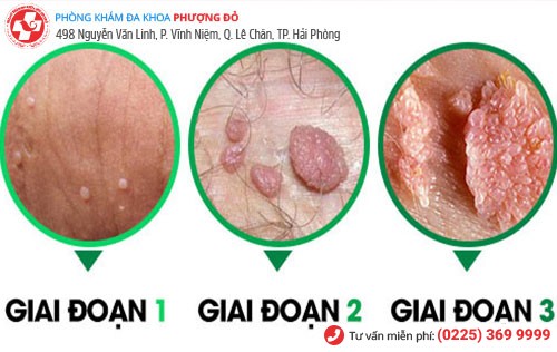 biểu hiện sùi mào gà