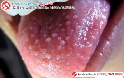 biểu hiện sùi mào gà ở lưỡi