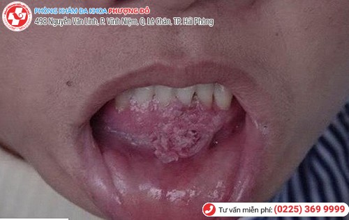 biểu hiện sùi mào gà ở miệng