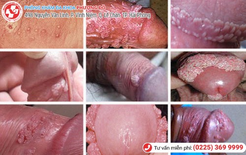 Biểu hiện sùi mào gà ở nam Biểu hiện sùi mào gà ở nam