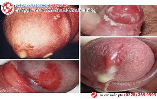 chảy mủ sinh dục