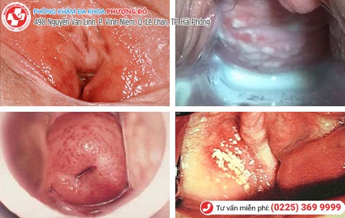 Các Bệnh Viêm Nhiễm Sinh Dục Ở Nữ