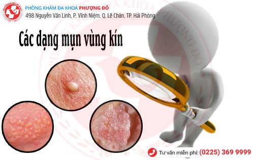 Các dạng mụn vùng kín ở nam và nữ Các dạng mụn vùng kín