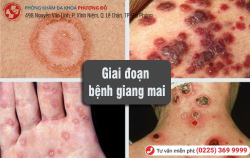 Bệnh giang mai có 4 giai đoạn phát triển Các giai đoạn bệnh giang mai