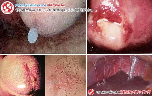 bệnh lây qua đường quan hệ tình dục