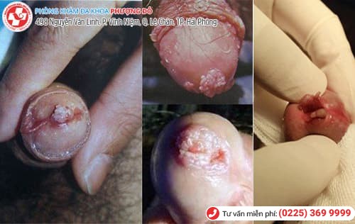 Chữa bệnh sùi mào gà ở đâu tốt nhất tại Hải Phòng? Chữa bệnh sùi mào gà ở đâu tốt nhất tại Hải Phòng?