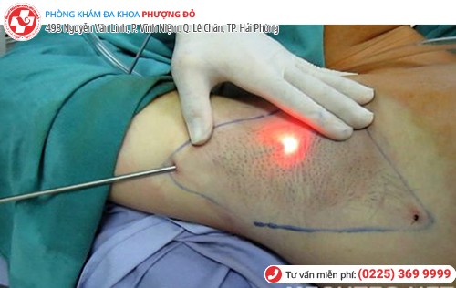 chữa trị bệnh hôi nách