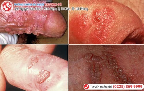 tác hại chữa sùi mào gà tại nhà tác hại chữa sùi mào gà tại nhà
