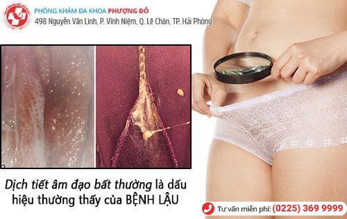 dấu hiệu bệnh lậu nữ dấu hiệu bệnh lậu nữ
