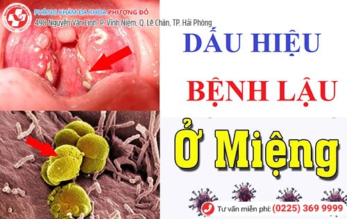 Hình ảnh bệnh lậu ở miệng Hình ảnh bệnh lậu ở miệng