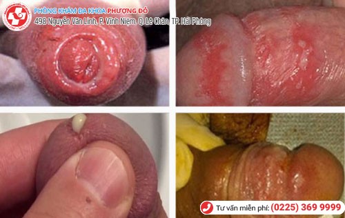 Dấu hiệu bệnh lậu ở bộ phận sinh dục của nam Dấu hiệu bệnh lậu ở nam