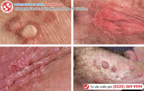 Dấu hiệu mụn cóc sinh dục Dấu hiệu mụn cóc sinh dục