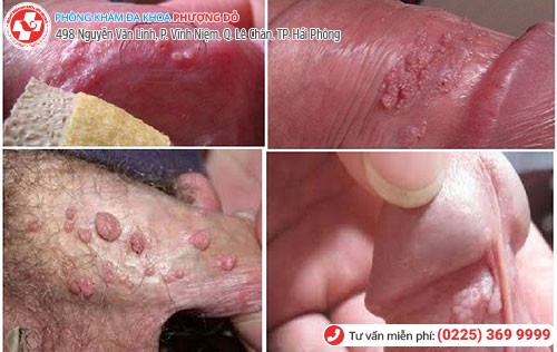 Hình ảnh sùi mào gà Hình ảnh sùi mào gà