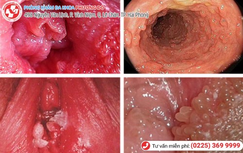 Dấu hiệu sùi mào gà ở tử cung Dấu hiệu sùi mào gà ở tử cung