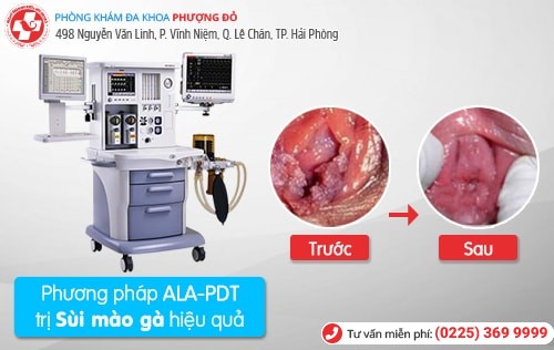 phương pháp chữa sùi mào gà phương pháp chữa sùi mào gà