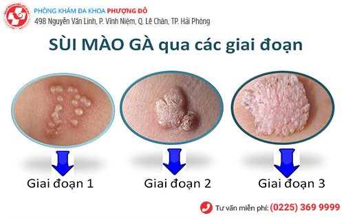Các giai đoạn phát triển của sùi mào gà Các giai đoạn phát triển của sùi mào gà