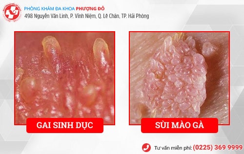 Đốt gai sinh dục bao nhiêu tiền? Đốt ở đâu giá rẻ, an toàn?