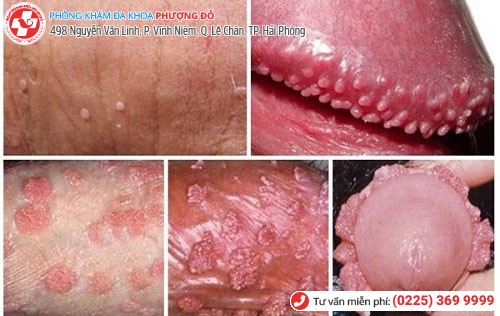 Hình ảnh nổi mụn dương vật