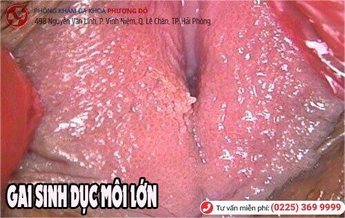 Gai sinh dục ở môi lớn Gai sinh dục môi lớn âm đạo