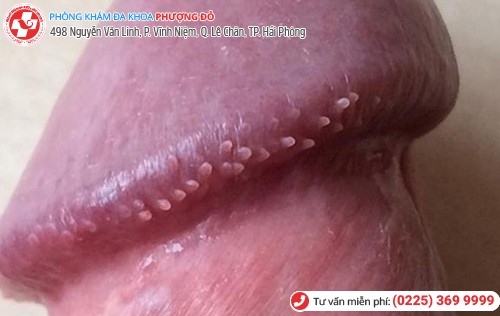 biểu hiện gai sinh dục nam
