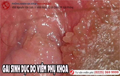 Gai sinh dục ở nữ Gai sinh dục ở nữ giới