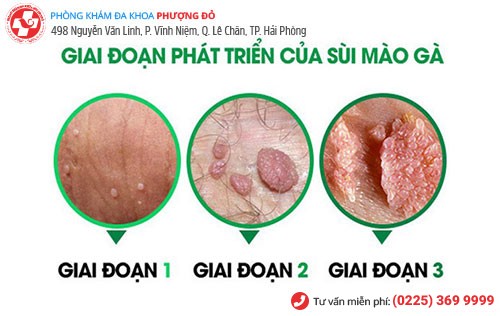Hình ảnh sùi mào gà qua các giai đoạn Hình ảnh sùi mào gà qua các giai đoạn