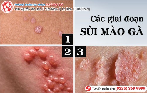 Sùi mào gà có 3 giai đoạn phát triển Các giai đoạn sùi mào gà