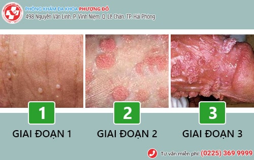 Các giai đoạn sùi mào gà