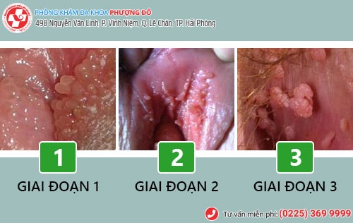Các giai đoạn sùi mào gà
