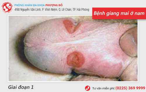 hình ảnh bệnh giang mai hình ảnh bệnh giang mai