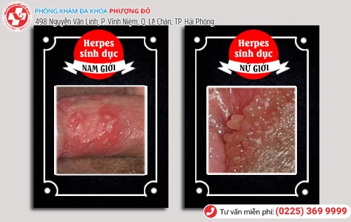 Triệu chứng của herpes sinh dục ở nam và nữ Herpes sinh dục ở nam và nữ