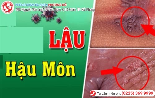 bệnh lậu ở hậu môn