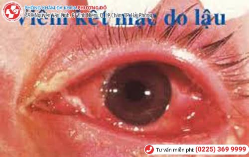 bệnh lậu ở mắt
