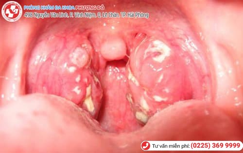 bệnh lậu ở miệng