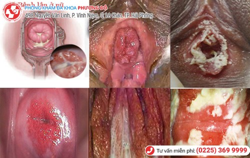 bệnh lậu ở nữ