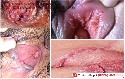 Hình ảnh bệnh sùi mào gà ở cơ quan sinh dục Hình ảnh bệnh sùi mào gà ở cơ quan sinh dục