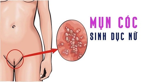 Mụn rộp sinh dục ở cơ quan sinh dục nữ Mụn rộp sinh dục ở cơ quan sinh dục nữ