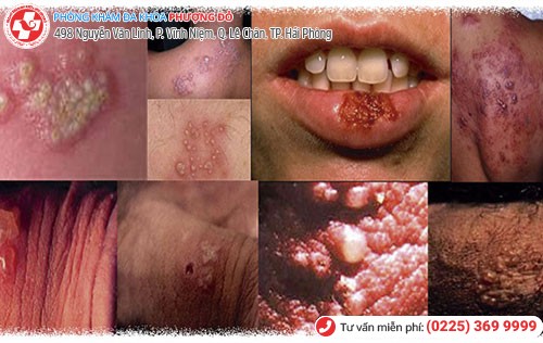 Hình ảnh mụn rộp sinh dục ở các vị trí trên cơ thể Hình ảnh mụn rộp sinh dục ở các vị trí trên cơ thể
